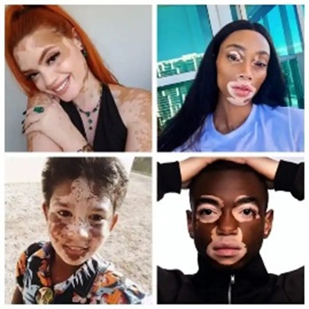VIPOC_Vitiligo_Brussels3